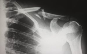 National Osteoporosis Month