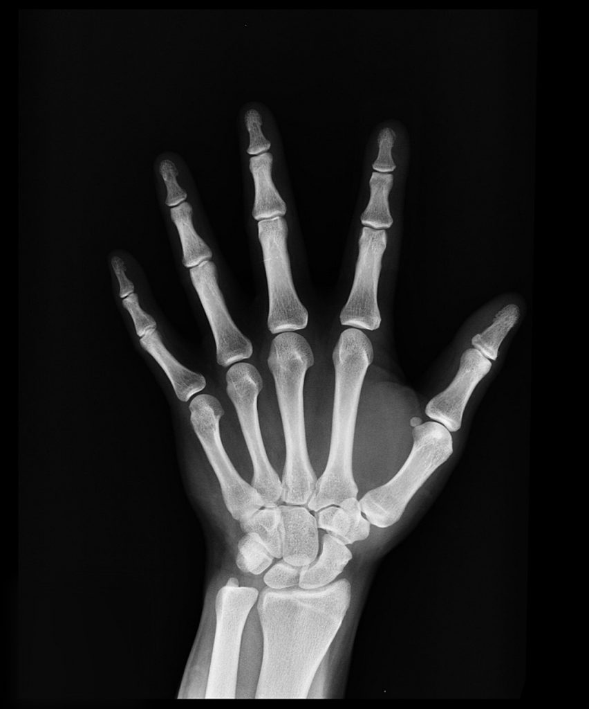 My X-Ray Says I Have What? Words Matter
