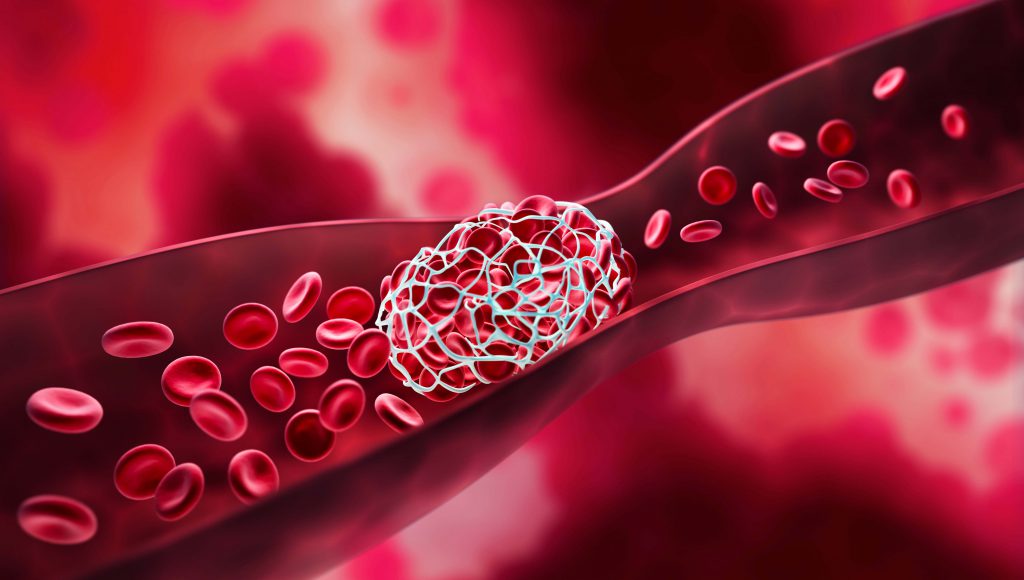 How Physical Therapy Can Help with Blood Clots